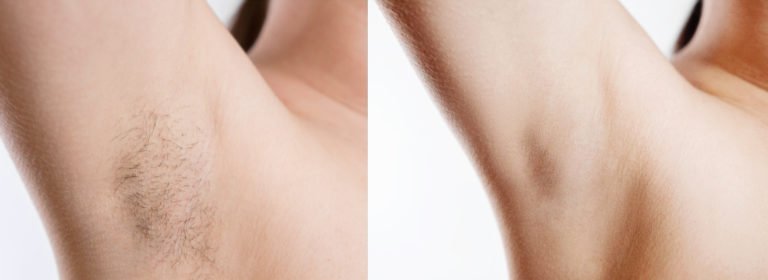 LASER HAIR REMOVAL JERSEY - Jersey Island Envy Beauty Salon
