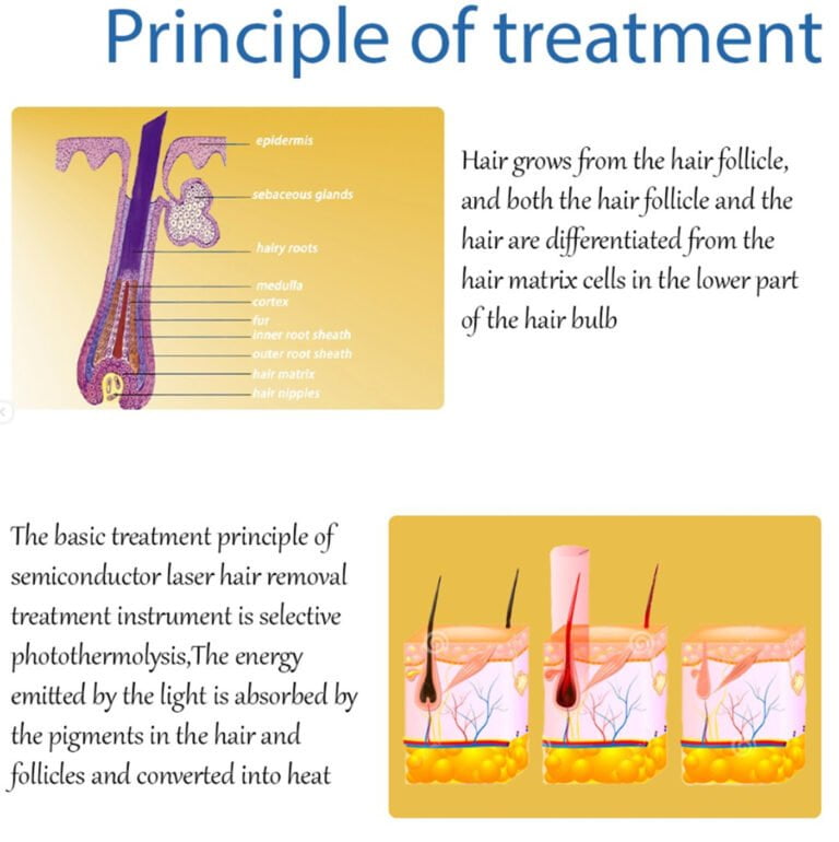 Information - laser hair removal. Principle of treatments